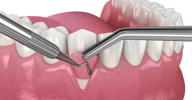Soft Tissue Grafts